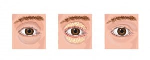 aesthetic blepharoplasty eye